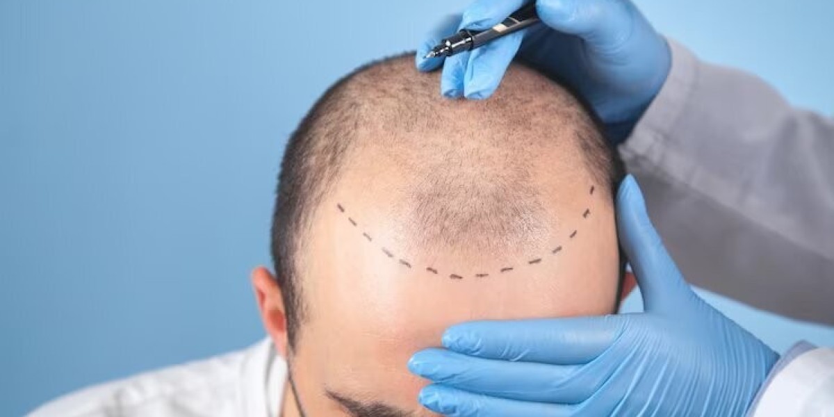 Find Your Ideal Fut Hair Transplant Cost: Expert Recommendations