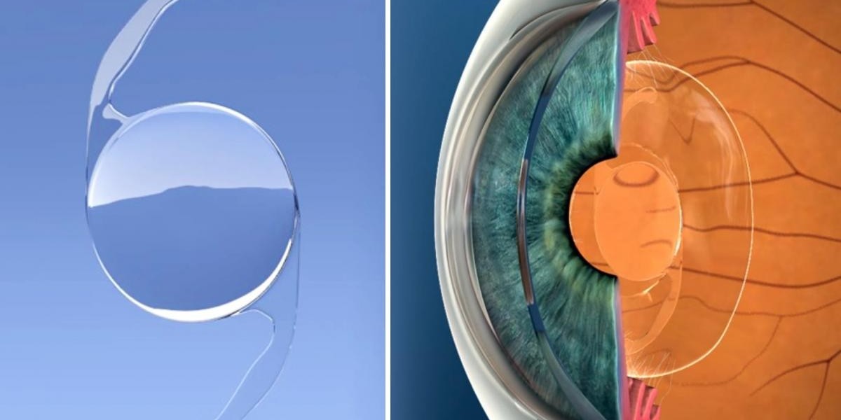 Global Intraocular Lens Market Share & Upcoming Industry Growth | Report Covers Industry Insights on Regional Compet
