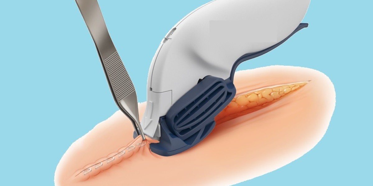 Global Surgical Staplers Market Share & Upcoming Industry Growth | Report Covers Industry Insights on Regional Compe