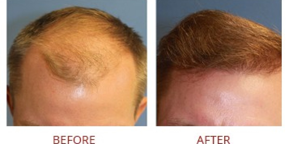 Precision Hair Restoration: Top Follicular Unit Extraction Clinics Revealed
